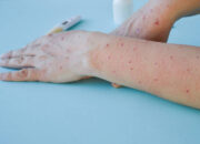 Waspada! Anak-anak Berisiko Lebih Tinggi Terkena Cacar Monyet