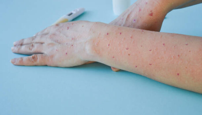 Waspada! Anak-anak Berisiko Lebih Tinggi Terkena Cacar Monyet